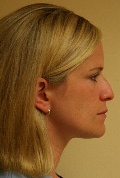 Before - right_lateral