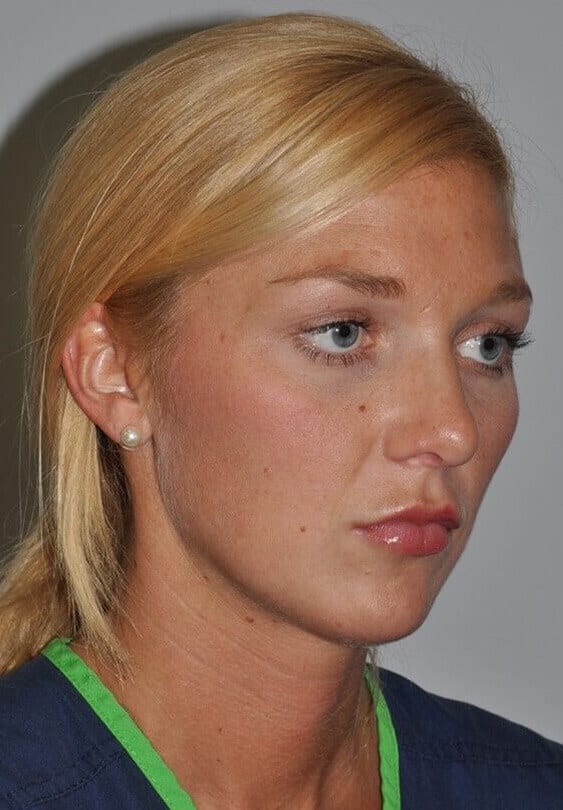 Before - right_oblique