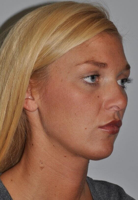 After - right_oblique