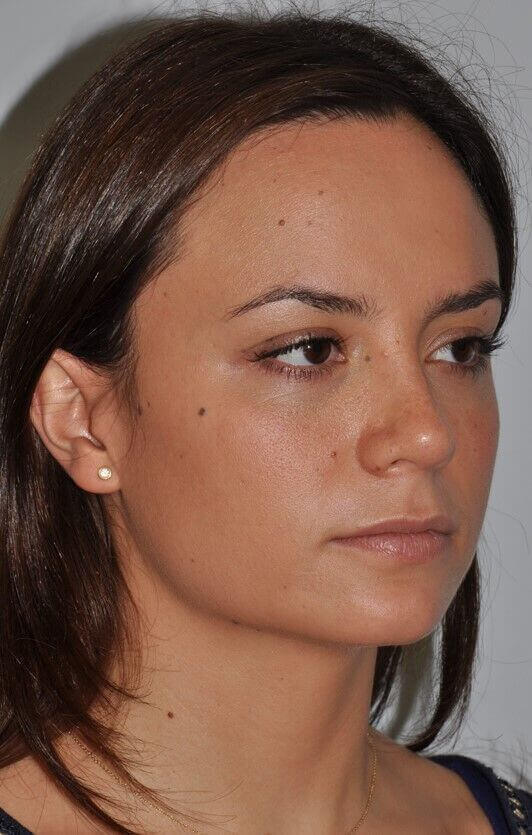 After - right_oblique