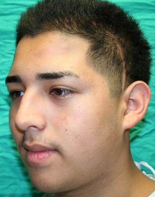 Before - left_oblique