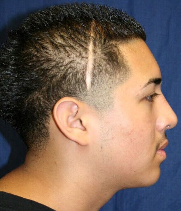 Before - right_lateral