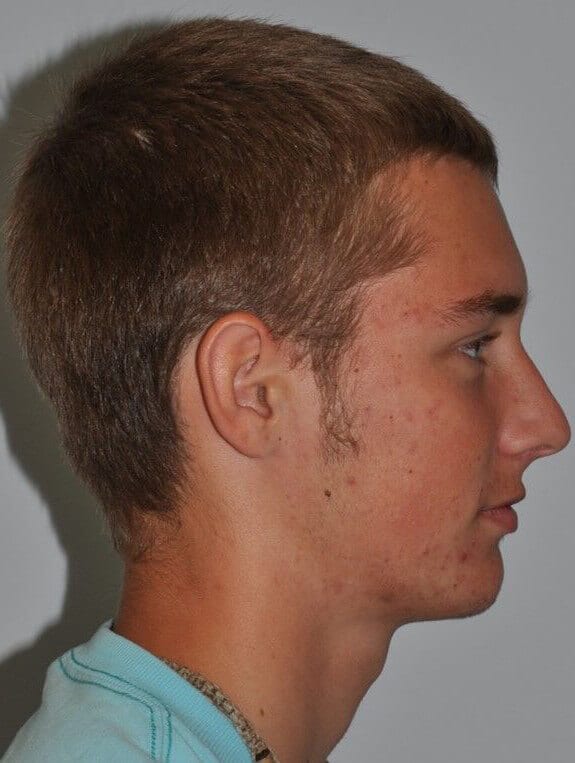 After - right_lateral