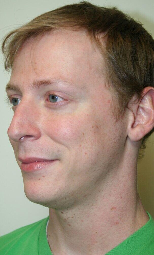 Before - left_oblique