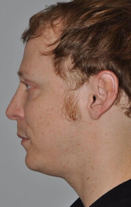 After - left_lateral