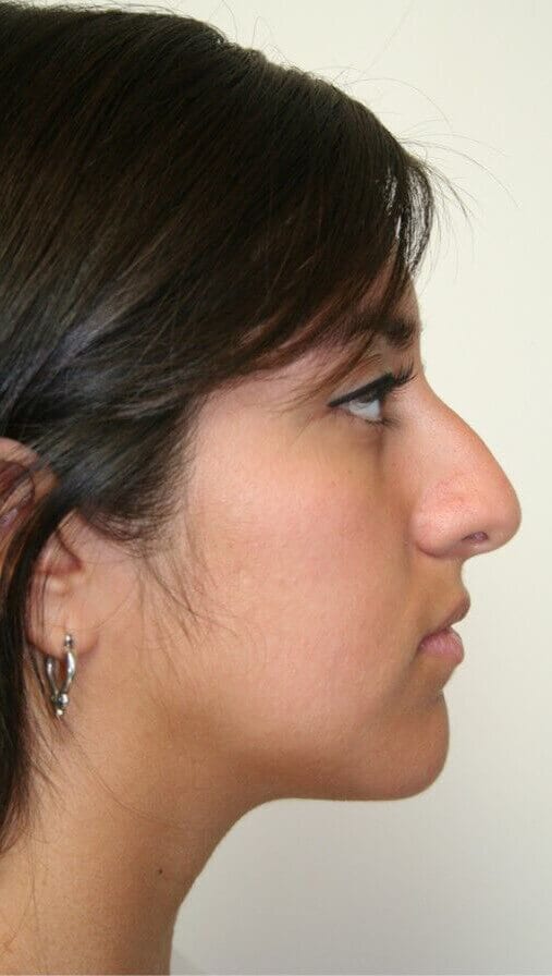 Before - right_lateral