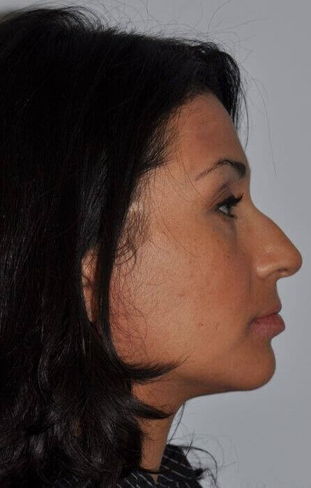 Before - right_lateral