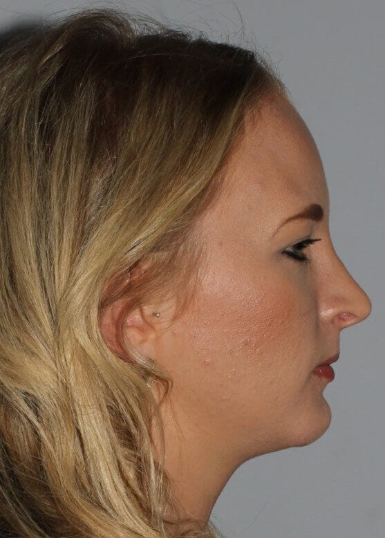 After - right_lateral