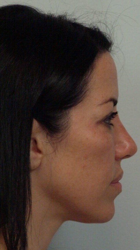 After - right_lateral