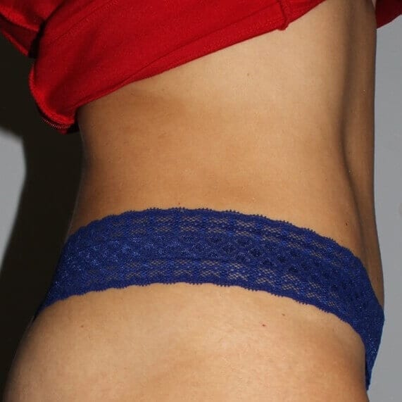 After - right_lateral