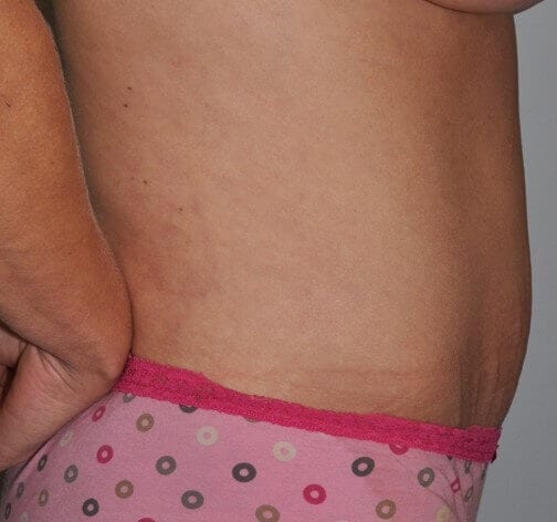 After - right_lateral