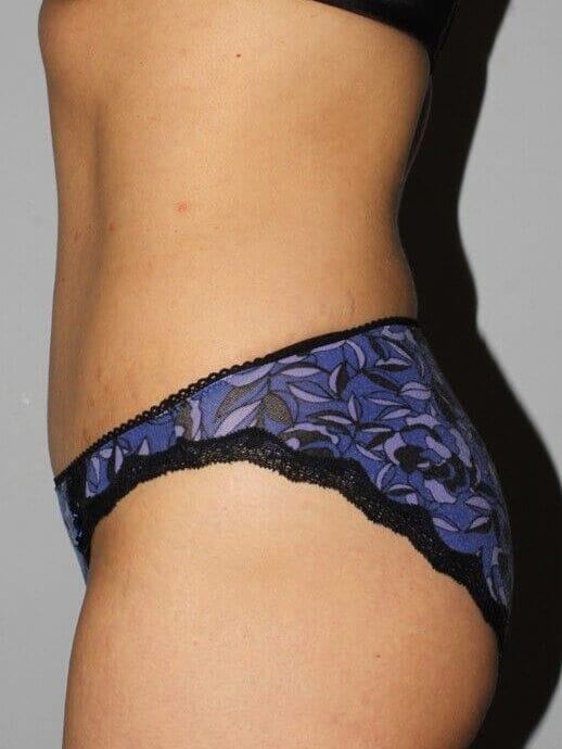 After - left_lateral