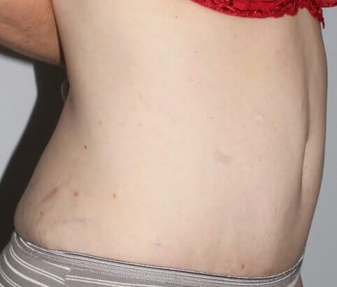 After - right_oblique