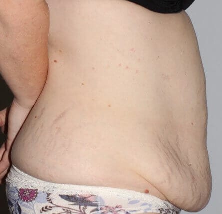 Before - right_lateral