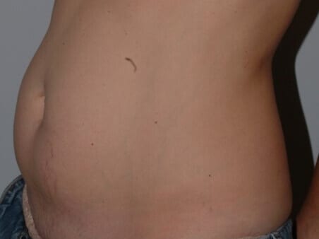 Before - left_oblique