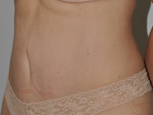 After - left_oblique