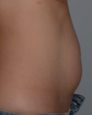 Before - right_lateral