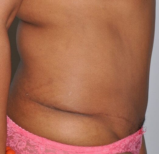 After - right_lateral