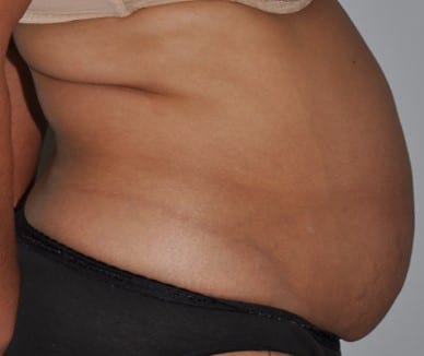 Before - right_lateral