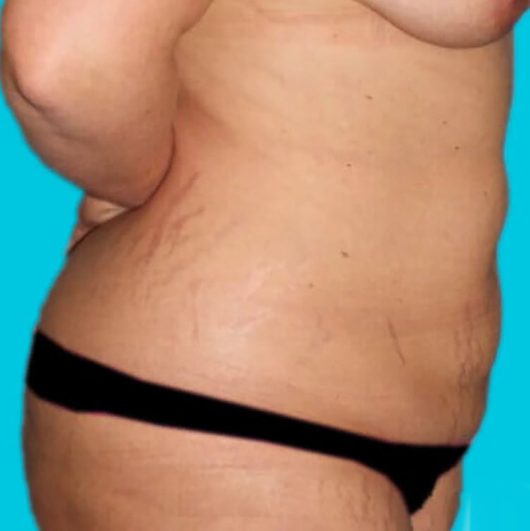 Before - right_lateral