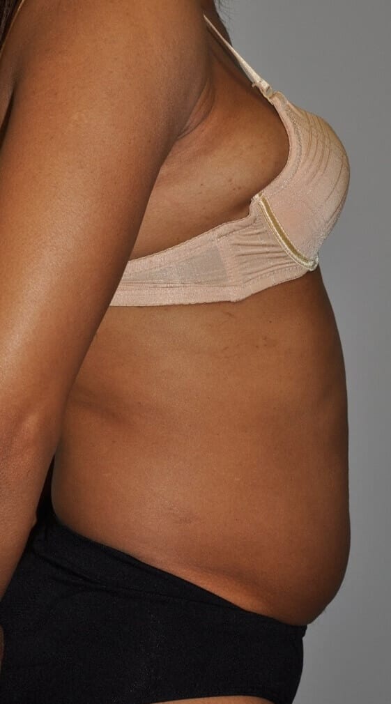 Before - right_lateral