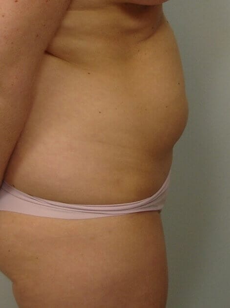 Before - right_lateral