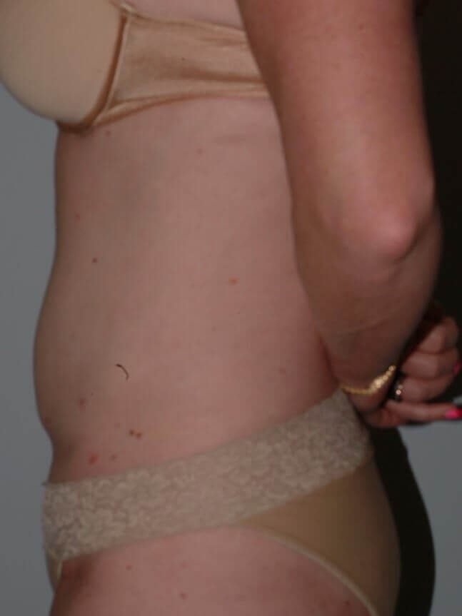 After - left_lateral