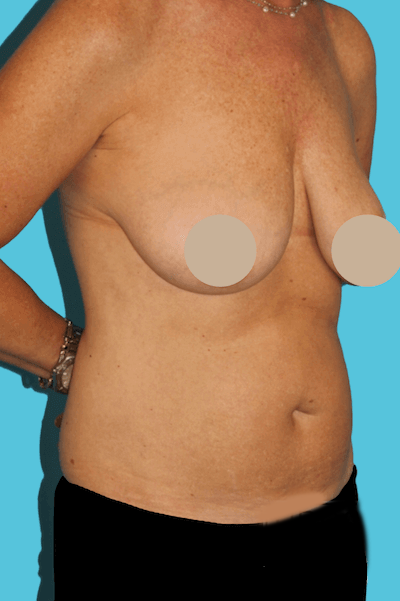 Before - right_oblique