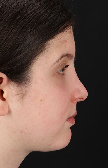 After - right_lateral