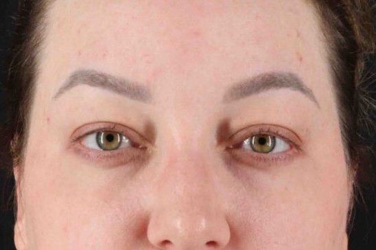 Before - 1151-1159-1549