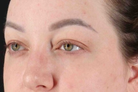 Before - left_oblique