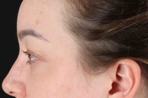 Before - left_lateral