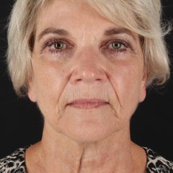 Neck Lift Before & After Patient #6654