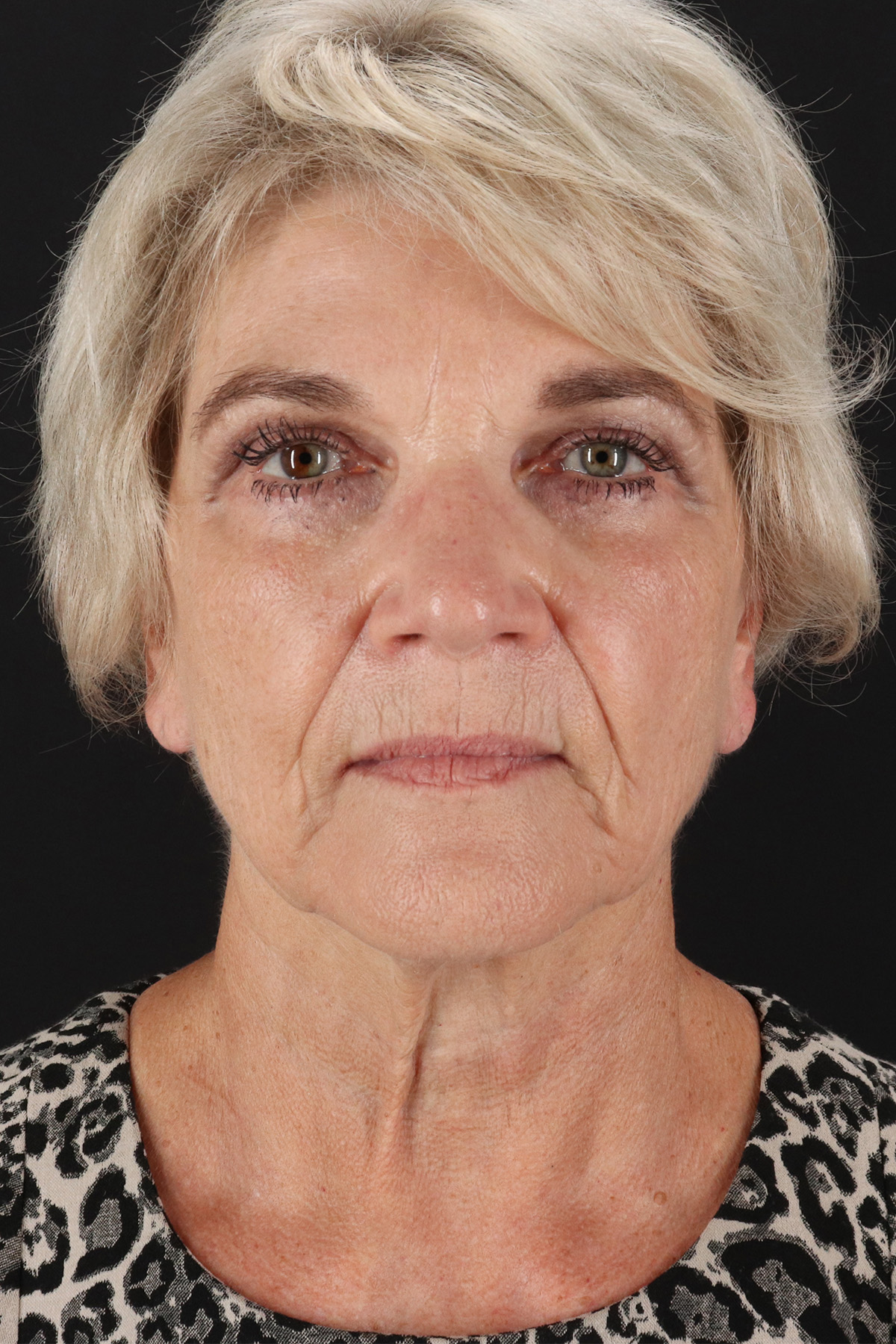 Neck Lift Before & After Patient #6654