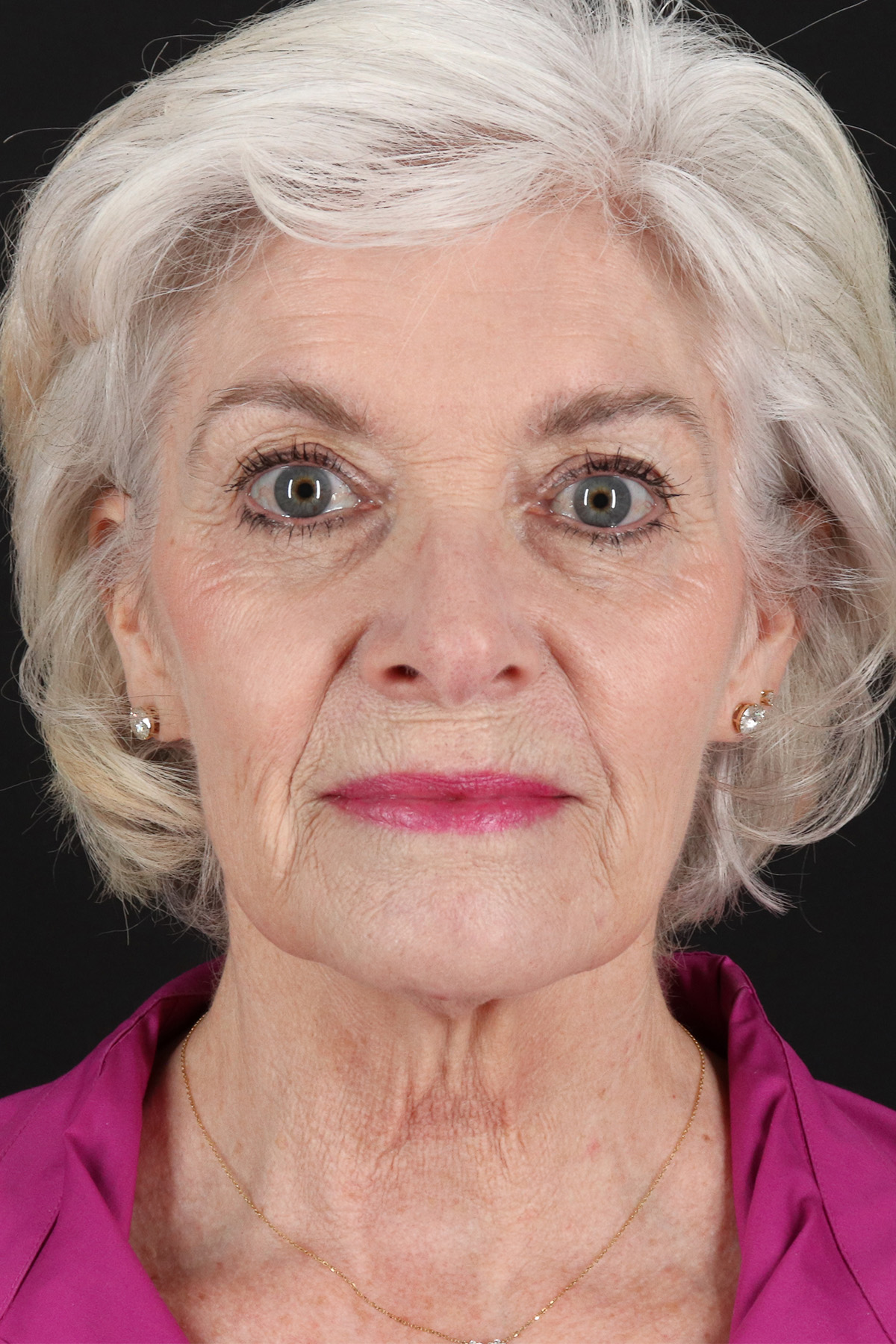 Neck Lift Before & After Patient #6665