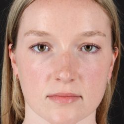 Liquid Rhinoplasty Before & After Patient #6425