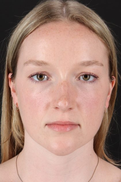 Liquid Rhinoplasty Before & After Patient #6425