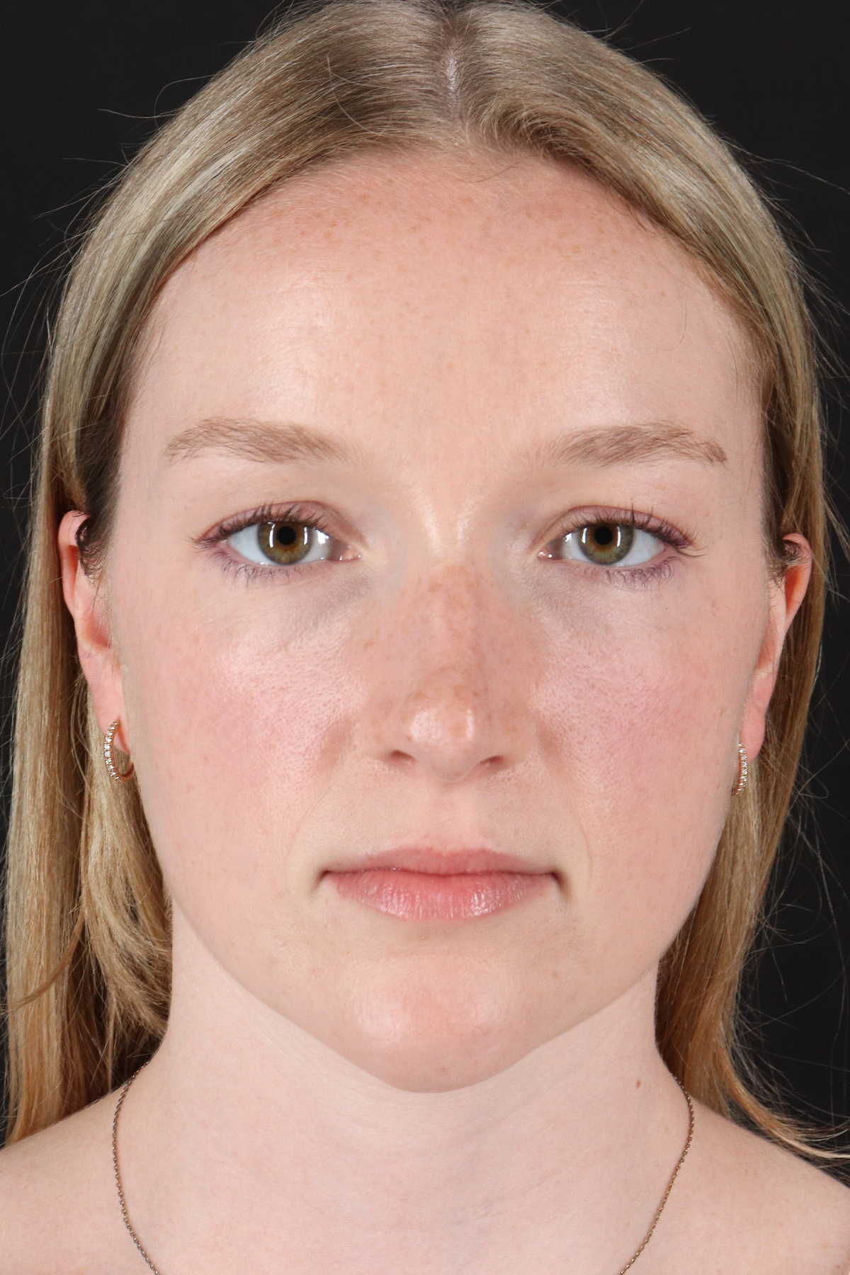 Liquid Rhinoplasty Before & After Patient #6425