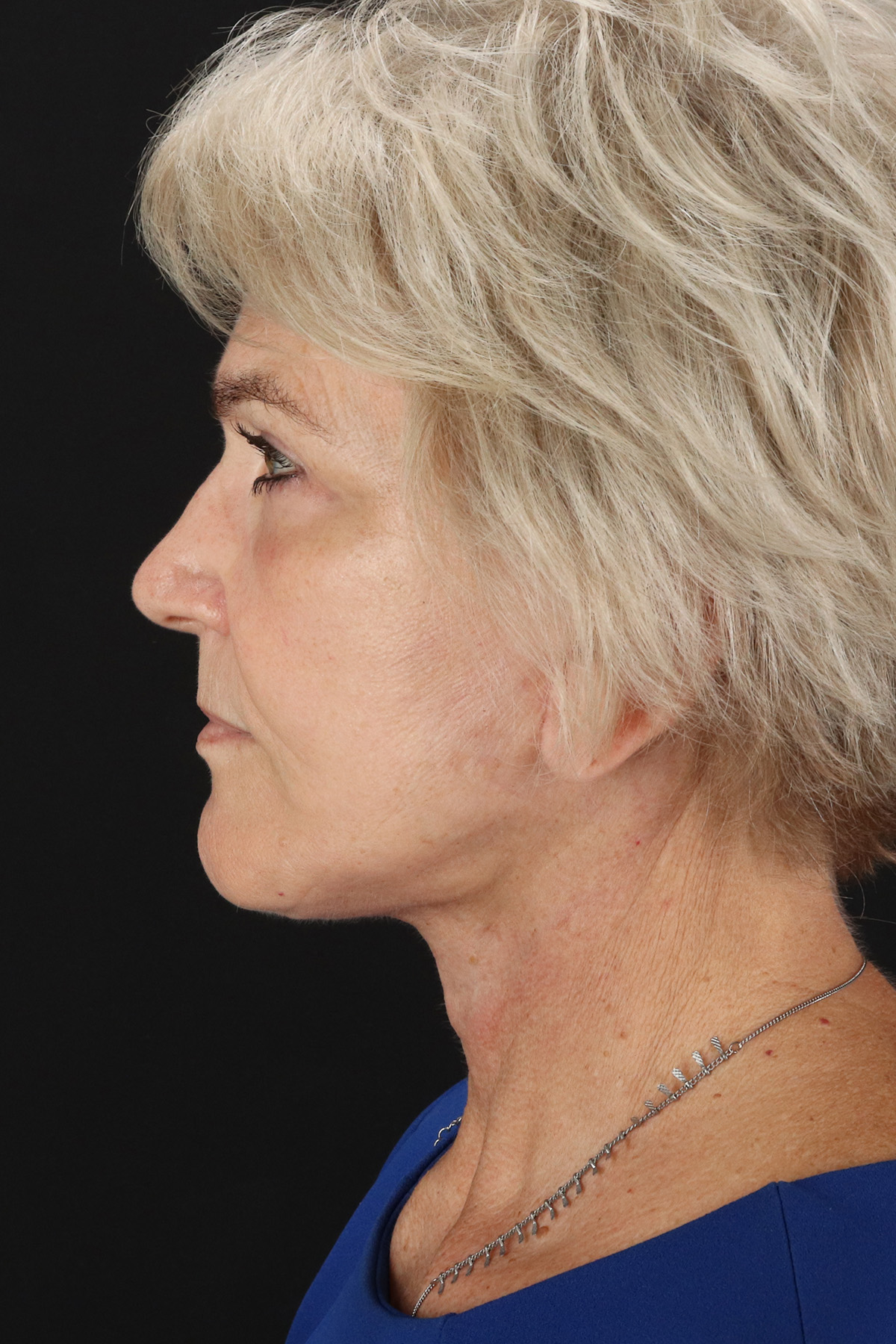 Neck Lift Before & After Patient #6654