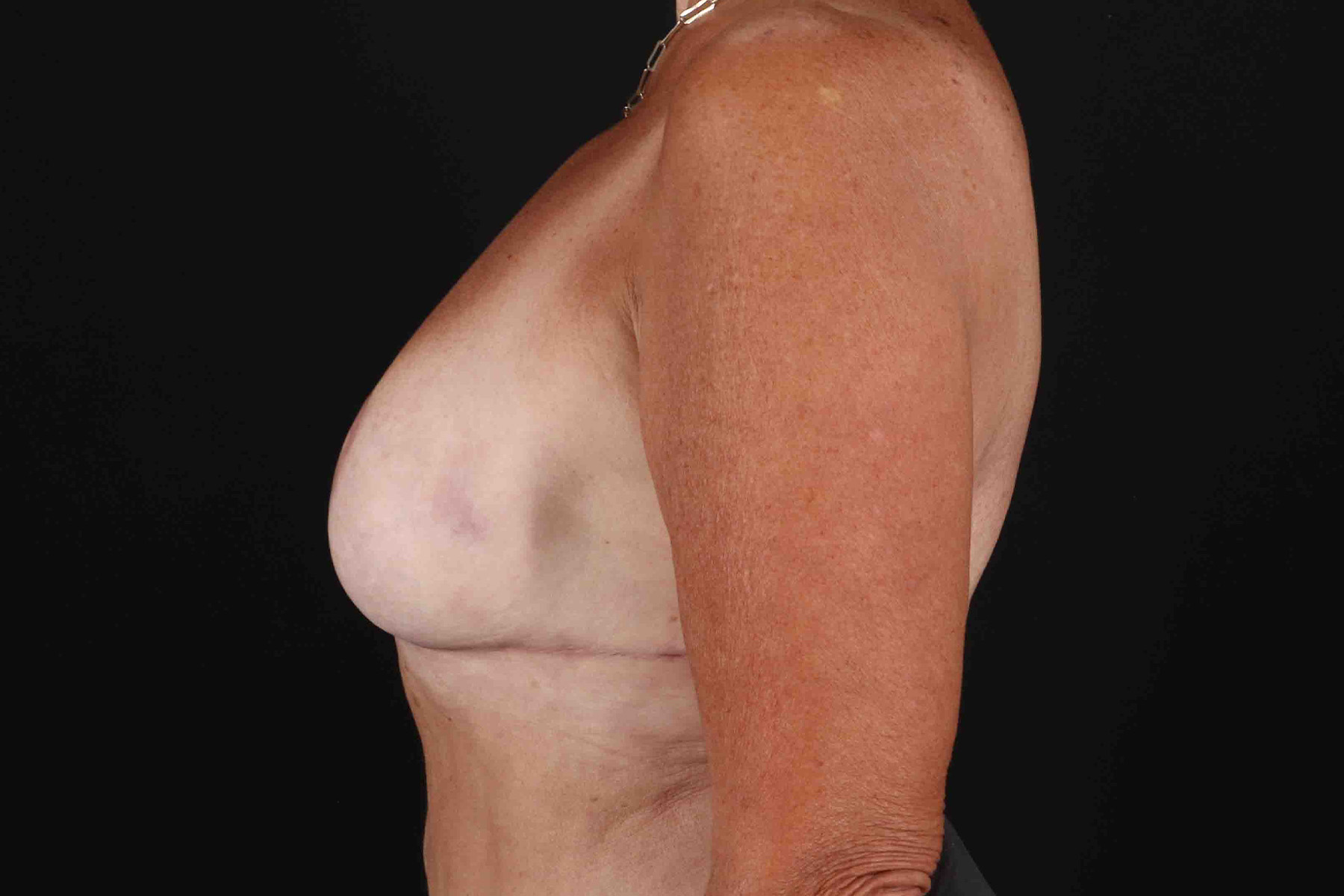 Breast Reduction With Lift Before & After Patient #3312