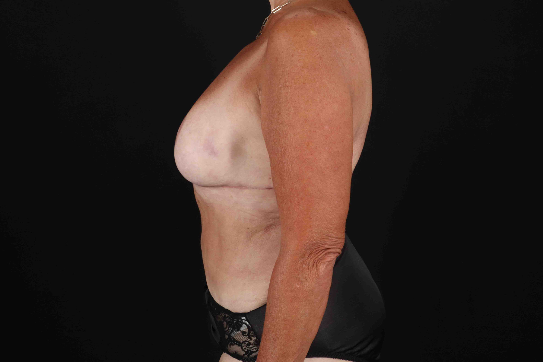Mommy Makeover Before & After Patient #1584