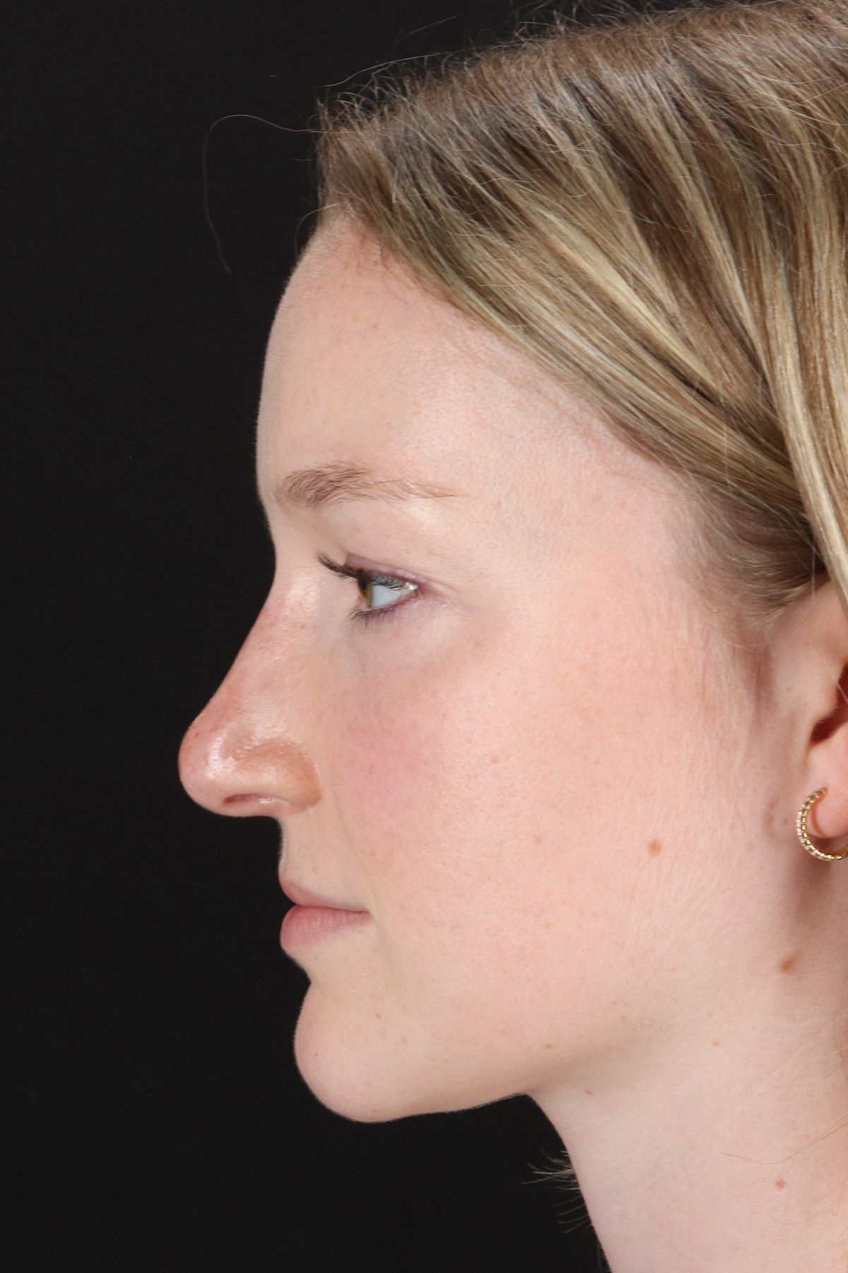 Liquid Rhinoplasty Before & After Patient #6425