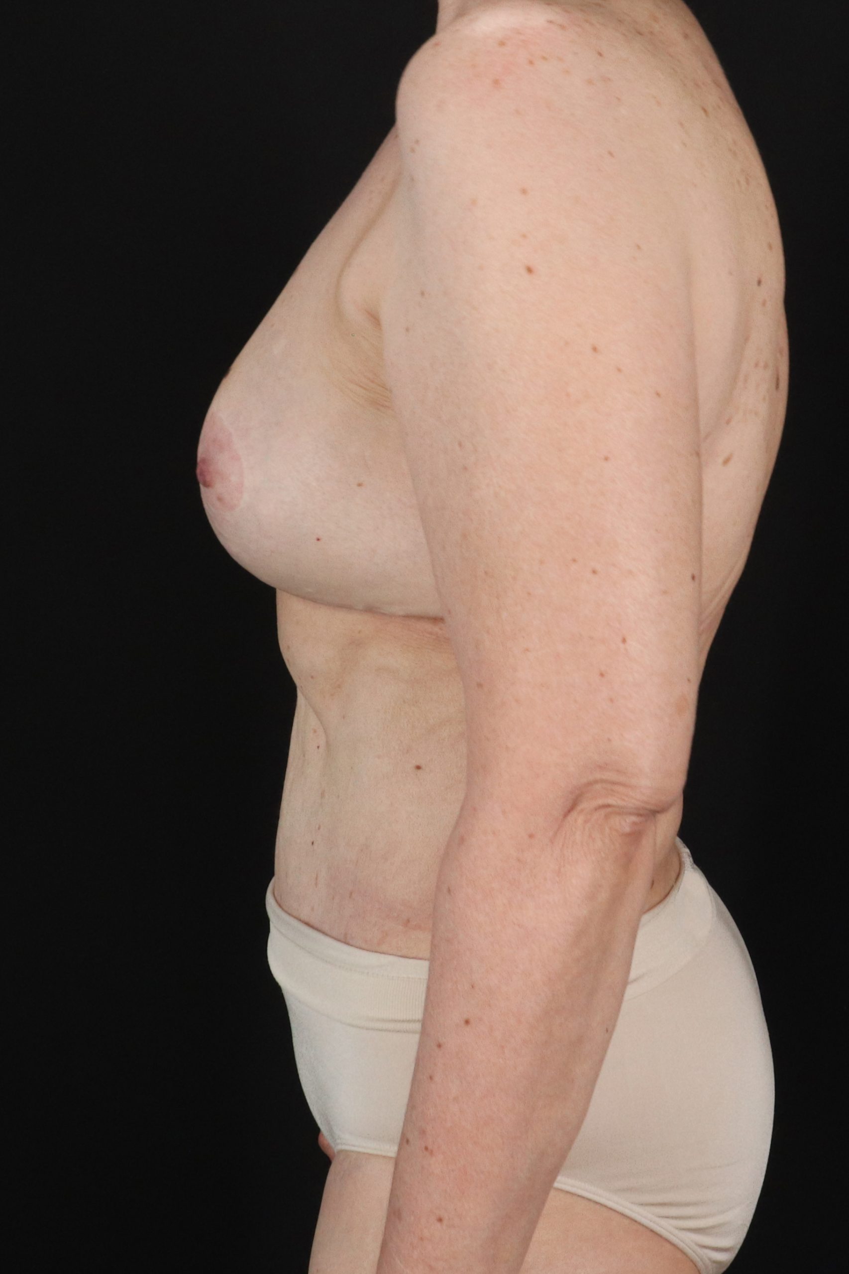 All Me Augmentation Before & After Patient #2914