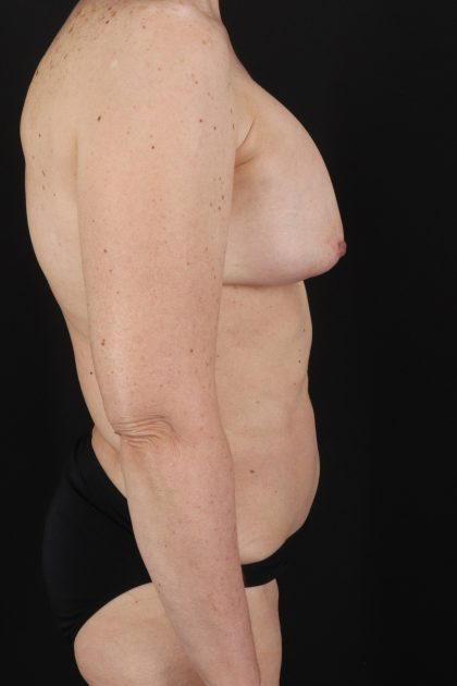 All Me Augmentation Before & After Patient #2914