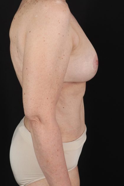 All Me Augmentation Before & After Patient #2914
