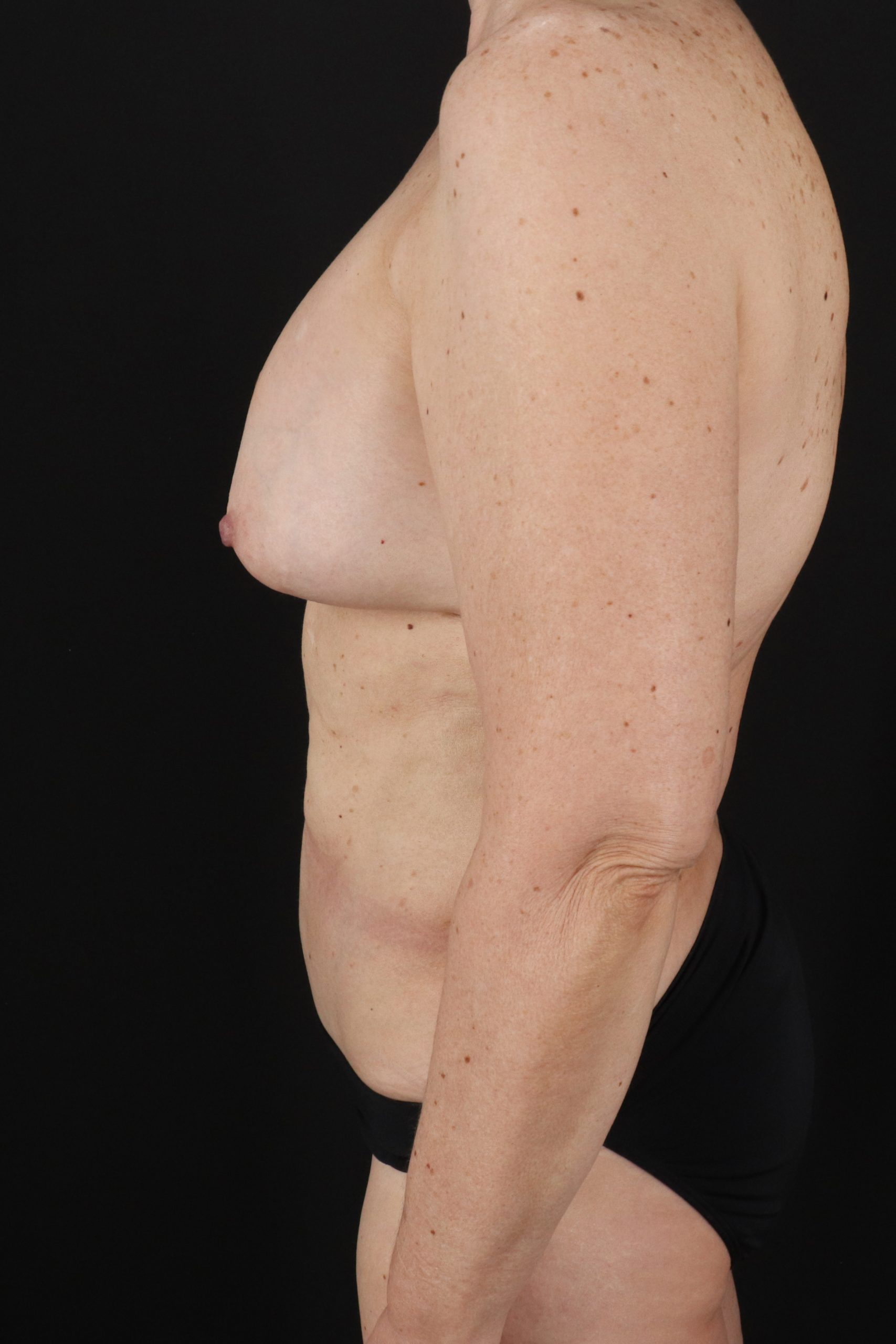 All Me Augmentation Before & After Patient #2914