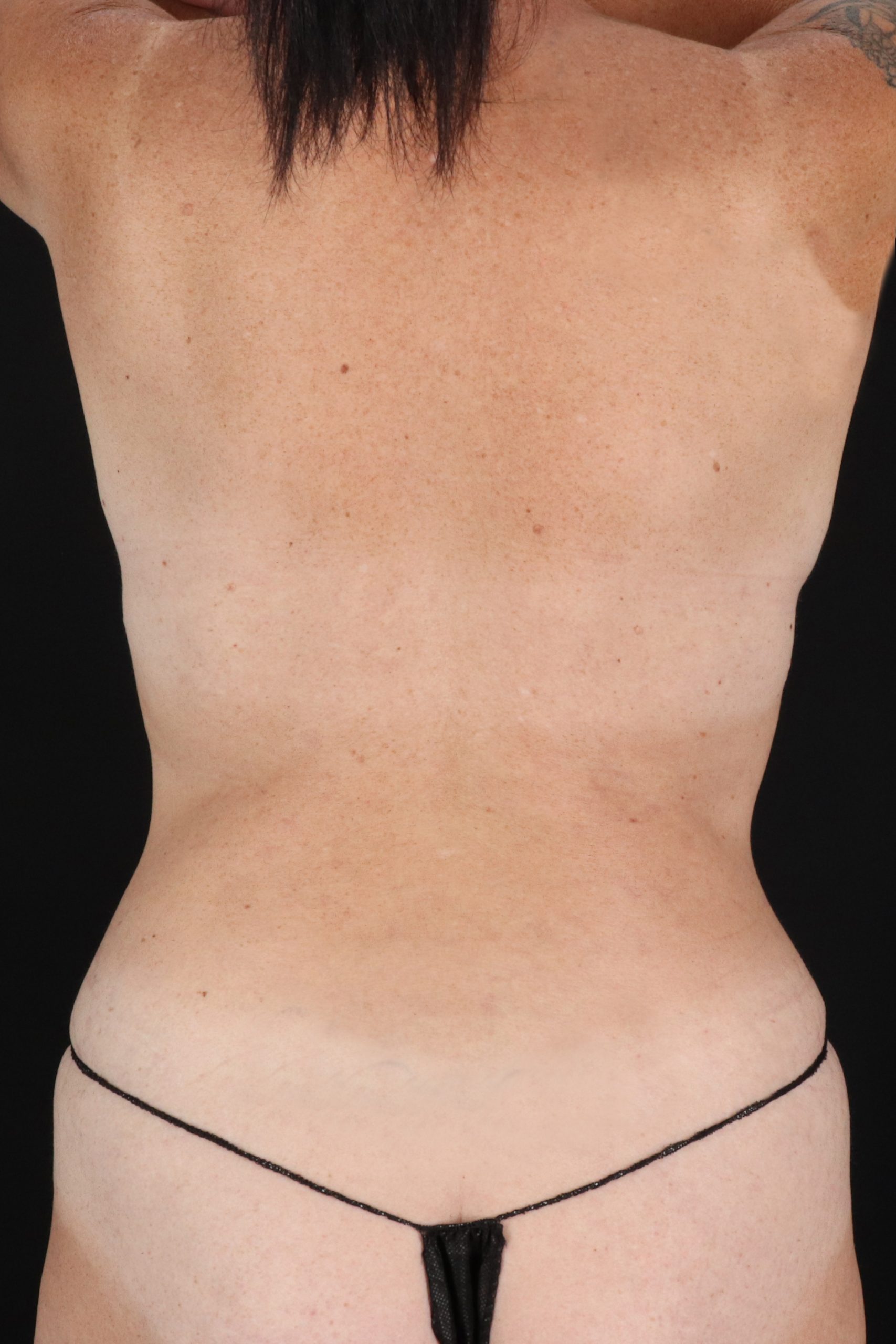 All Me Augmentation Before & After Patient #2906