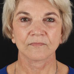 Neck Lift Before & After Patient #6654