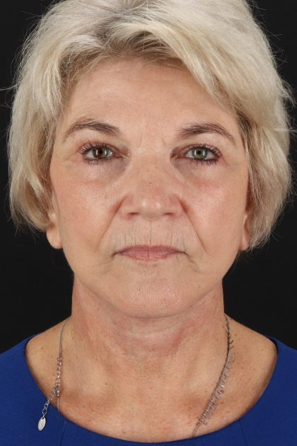 Neck Lift Before & After Patient #6654