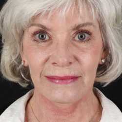 Neck Lift Before & After Patient #6665